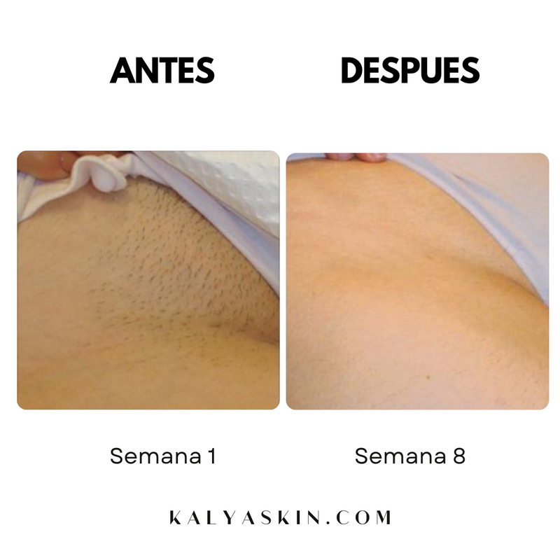 LIGHTKALYA Permanente IPL-Haarentfernung mit kostenlosem Peeling